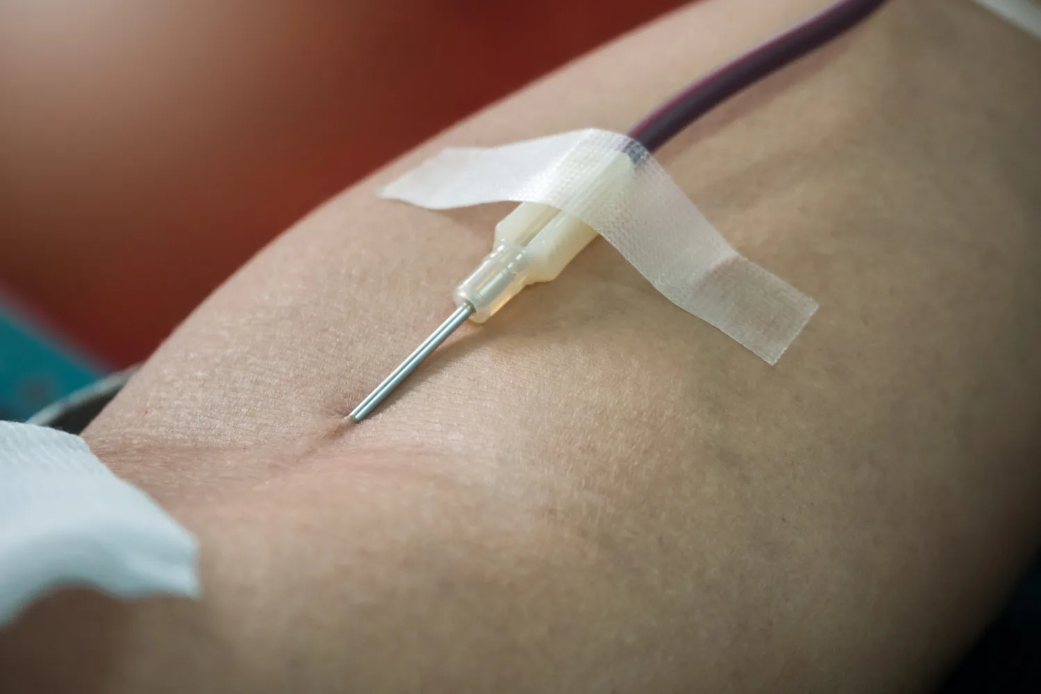 Cateterismo derecho y trombrofragmentación en CDMX: Procedimiento avanzado para tromboembolia pulmonar